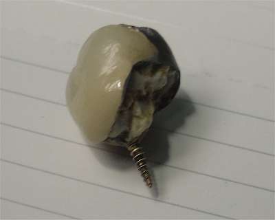 capped tooth showing the screw that held it in.