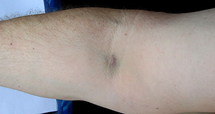 bruise left after
                          blood sample taken