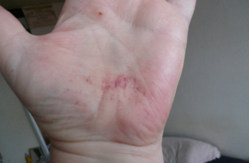 abrasions on my left
                      palm