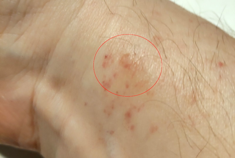 catheter entry point