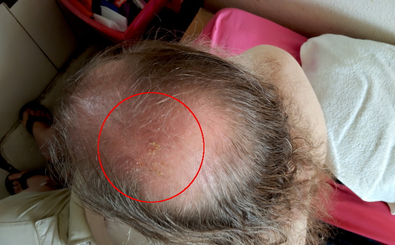 blister on the top of my
                                          head